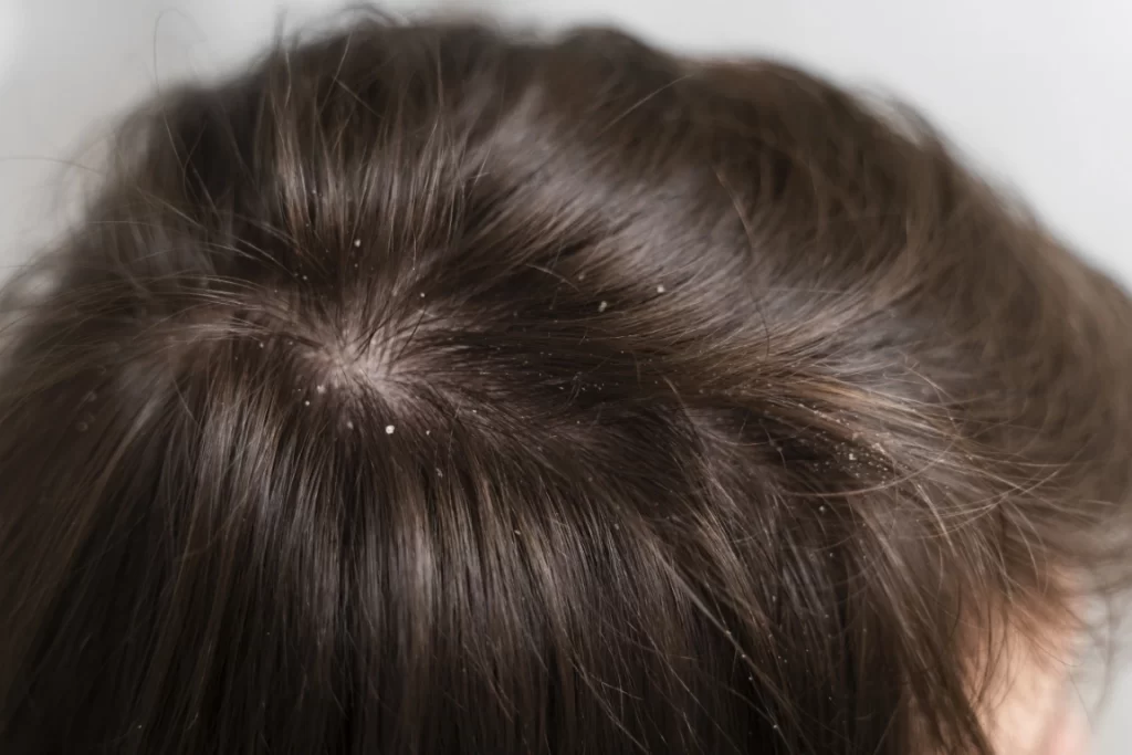 Close up of man's dandruff