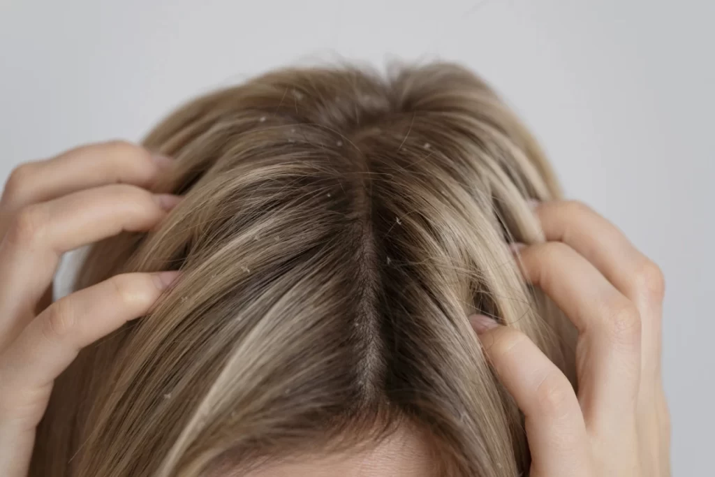 Close up of woman's dandruff